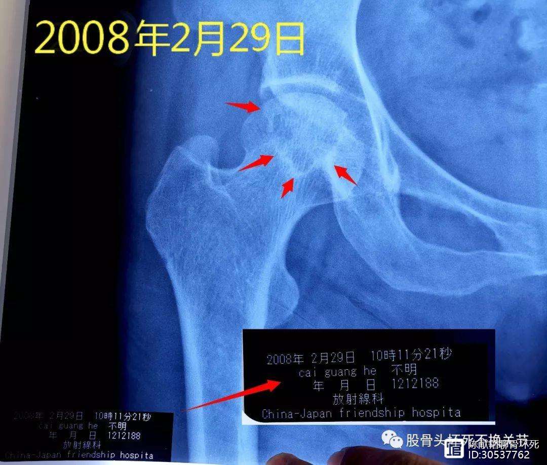 萍乡人工骨头医保报销多少(人工骨头医保报销多少比例)